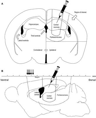 COX-2 Inhibition by Diclofenac Is Associated With Decreased Apoptosis and Lesion Area After Experimental Focal Penetrating Traumatic Brain Injury in Rats